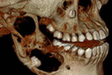 CT image of human jaw
