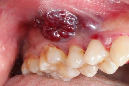 close up of lesions on gums of patient
