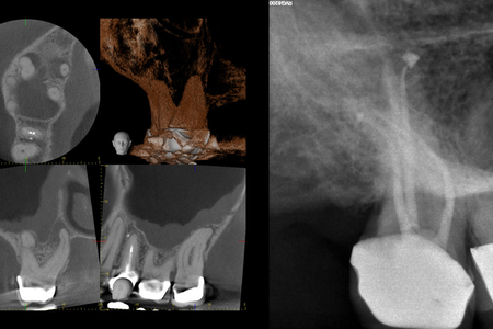 CBCT Endodontic Image