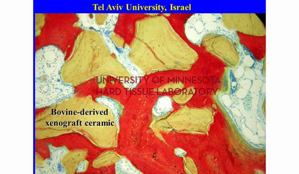 Tel Aviv University, Israel Bovine-derived xenograft ceramic