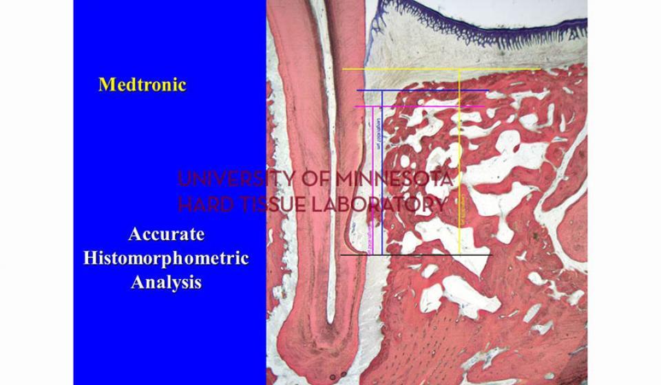Medtronic Acurate Mistomorphometric Analysis