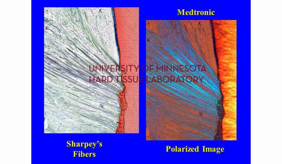 Sharpey's Fibers Medtronic Polarized Image