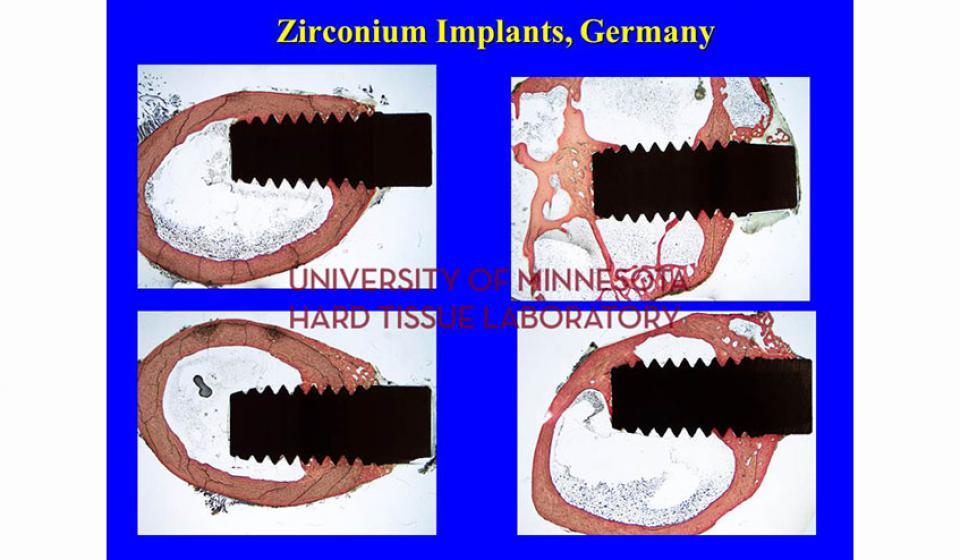 Zirconium Implants, Germany