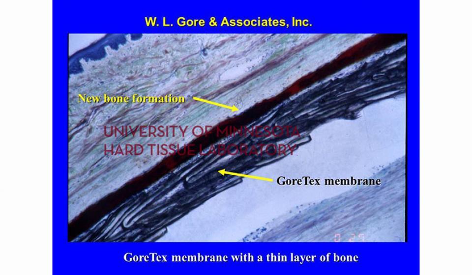 W. L. Gore &Associates, Inc. GoreTex membrane with a thin layer of bone