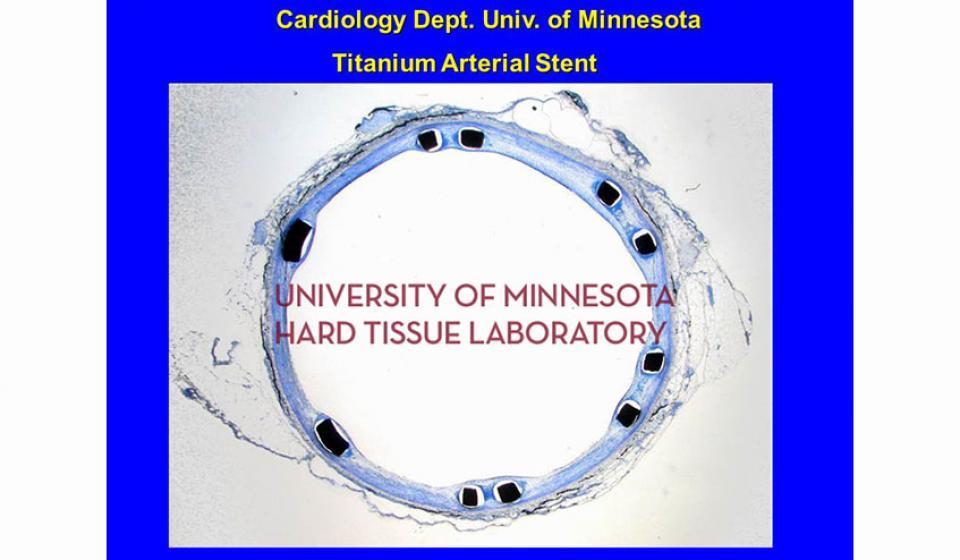 Cardiology Dept. Univ. of Minnesota Titanium Arterial Stent