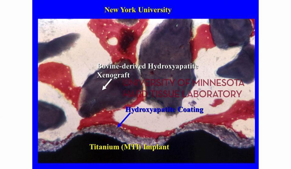 New York University Bovine-derived Hydroxyapatite Xenograft