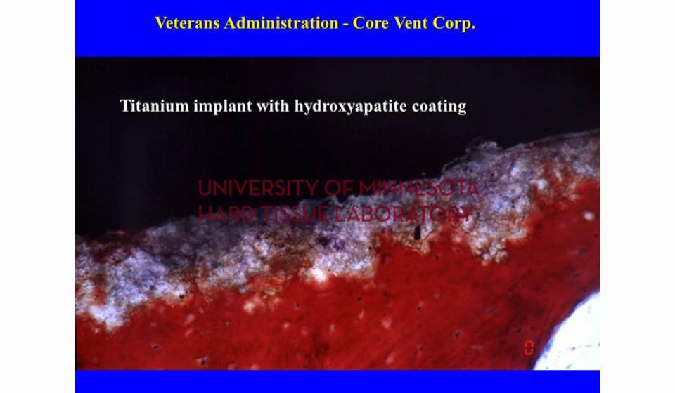 Veterans Administration - Core Vent Corp. Titanium implant with hydroxyapatite coating