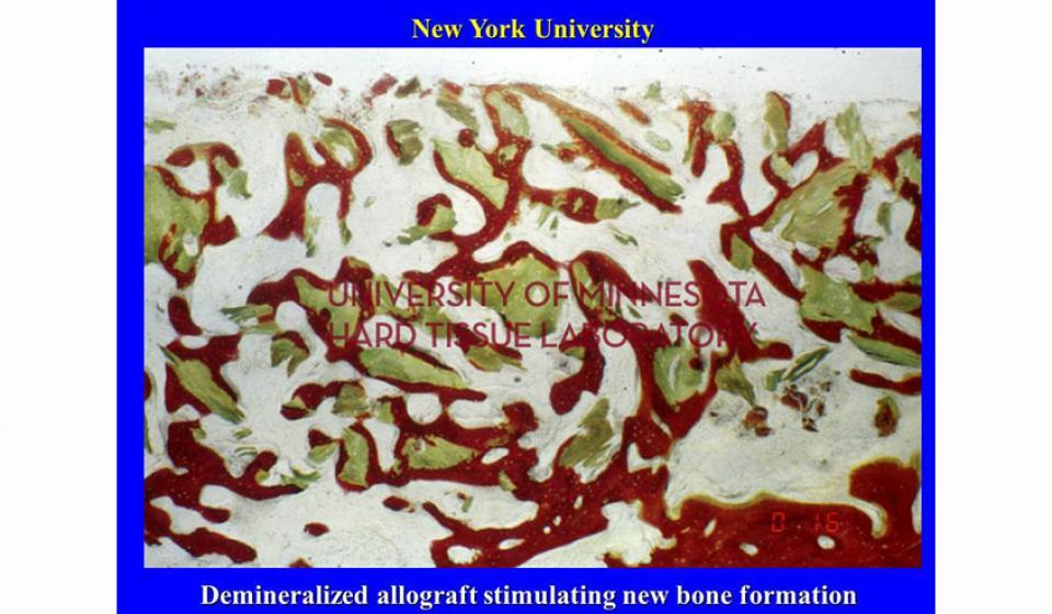 New York University Demineralized allograft stimulating new bone formation