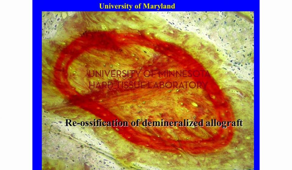 University of Maryland Re-ossification of demineralized allograft