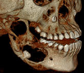 CT image of human jaw
