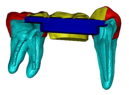 finite element analysis of a dental bridge. dental bridge illustration with different parts in different colors